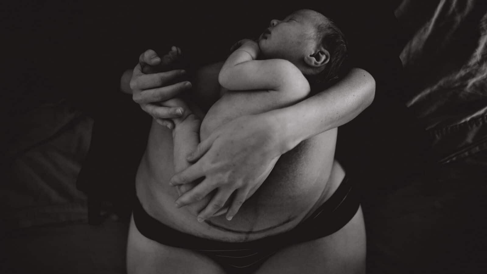 C-Section Scar Massage: Why it’s important and how to do it